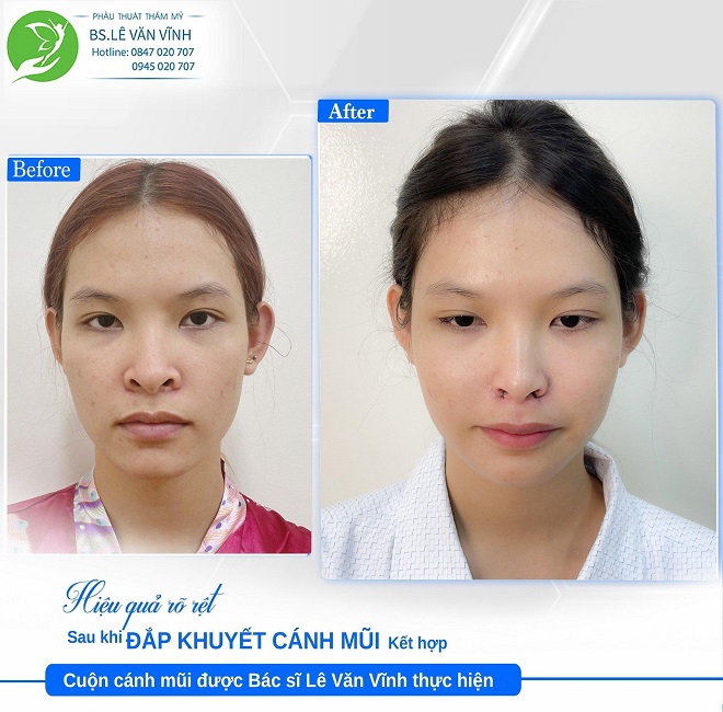 Đắp khuyết cánh mũi cải thiện dáng mũi hếch cùng bác sĩ Lê Văn Vĩnh.
