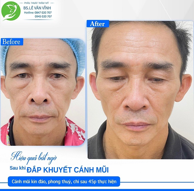 Bác sĩ Lê Văn Vĩnh luôn bảo đảm quy trình thẩm mỹ mũi đúng chuẩn y khoa, an toàn tuyệt đối cho mọi khách hàng.