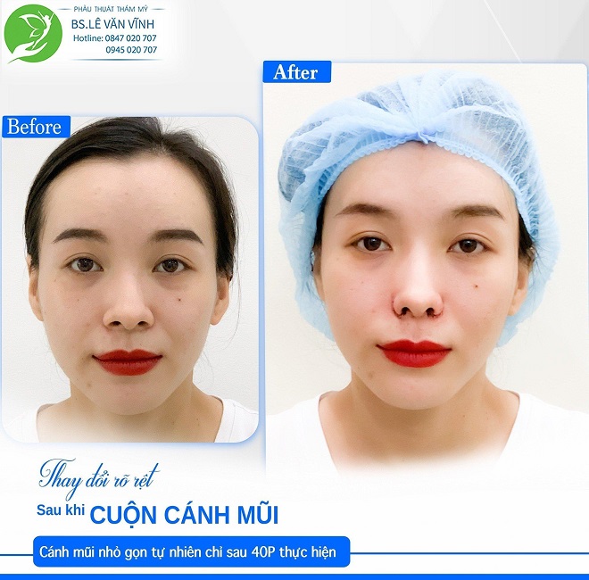 Thu gọn cánh mũi được trực tiếp Bác Sĩ Vĩnh thực hiện.