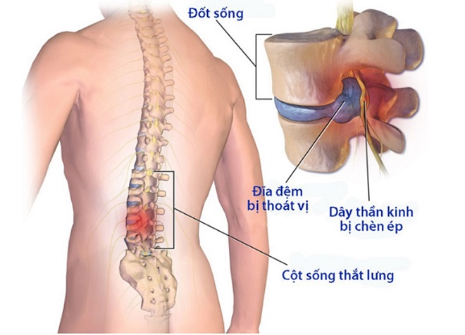 Thoái hóa cột sống là căn bệnh khiến người già gặp khó khăn trong sinh hoạt