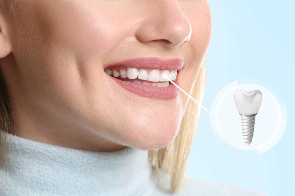 Răng Implant có thể tồn tại suốt đời nếu được chăm sóc đúng cách.