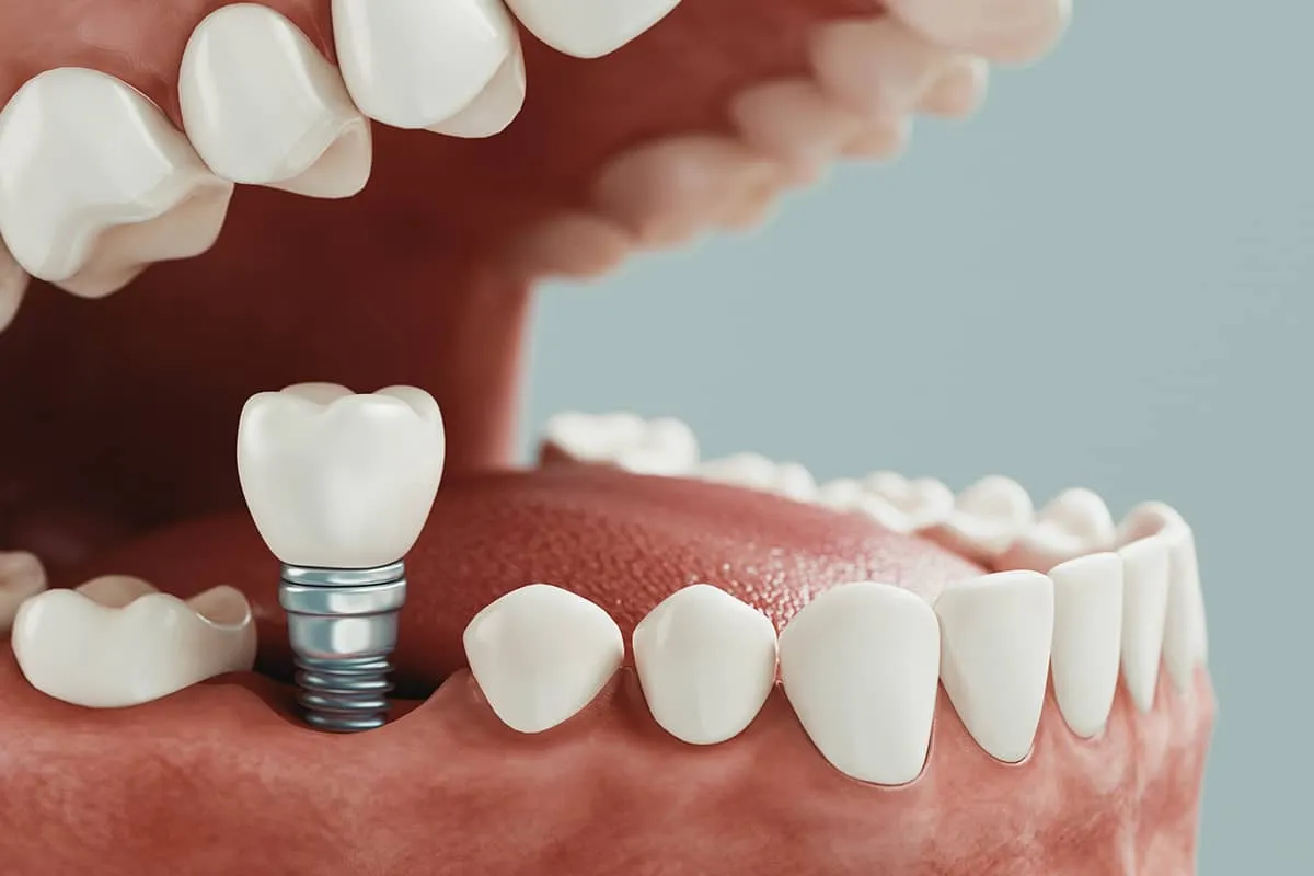 Răng Implant có cấu trúc, hình dáng và màu sắc tương tự như răng thật.