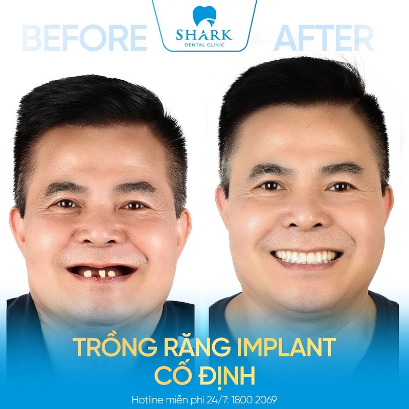 Cấy ghép Implant tại nha khoa Shark có thẩm mỹ cao và an toàn.