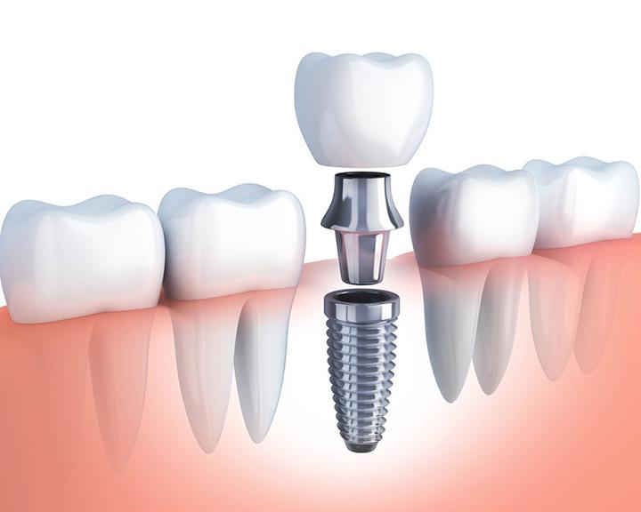 Trồng răng Implant có đau ko là thắc mắc của nhiều người khi quyết định áp dụng điều trị phương pháp này. 