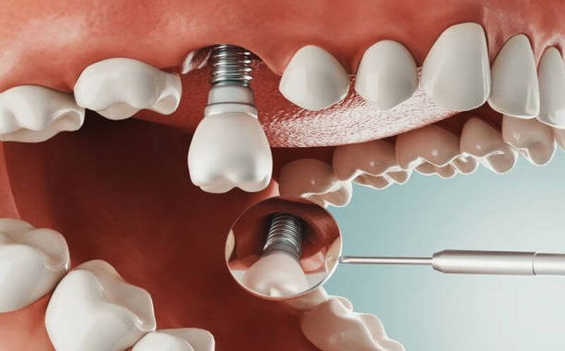 Trồng răng Implant là gì?