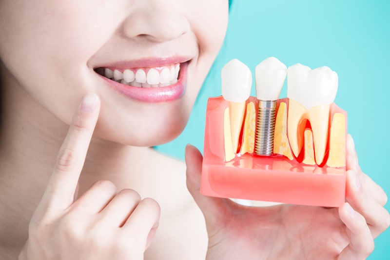 Nhu cầu tìm kiếm địa điểm cắm Implant ở đâu tốt hcm