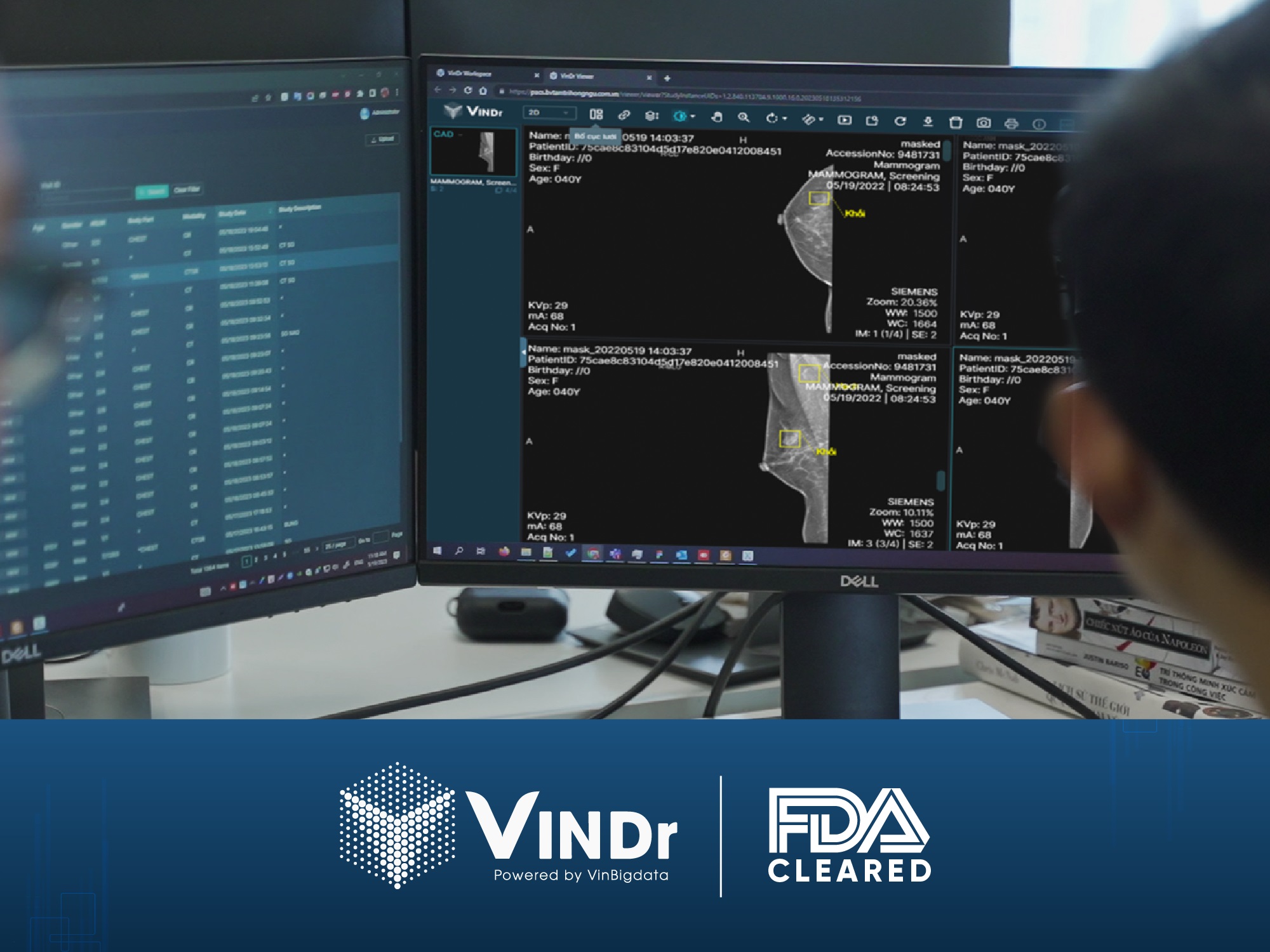  VinDr trở thành sản phẩm AI cho chẩn đoán X-quang tuyến vú đầu tiên và duy nhất tại Việt Nam được FDA công nhận.