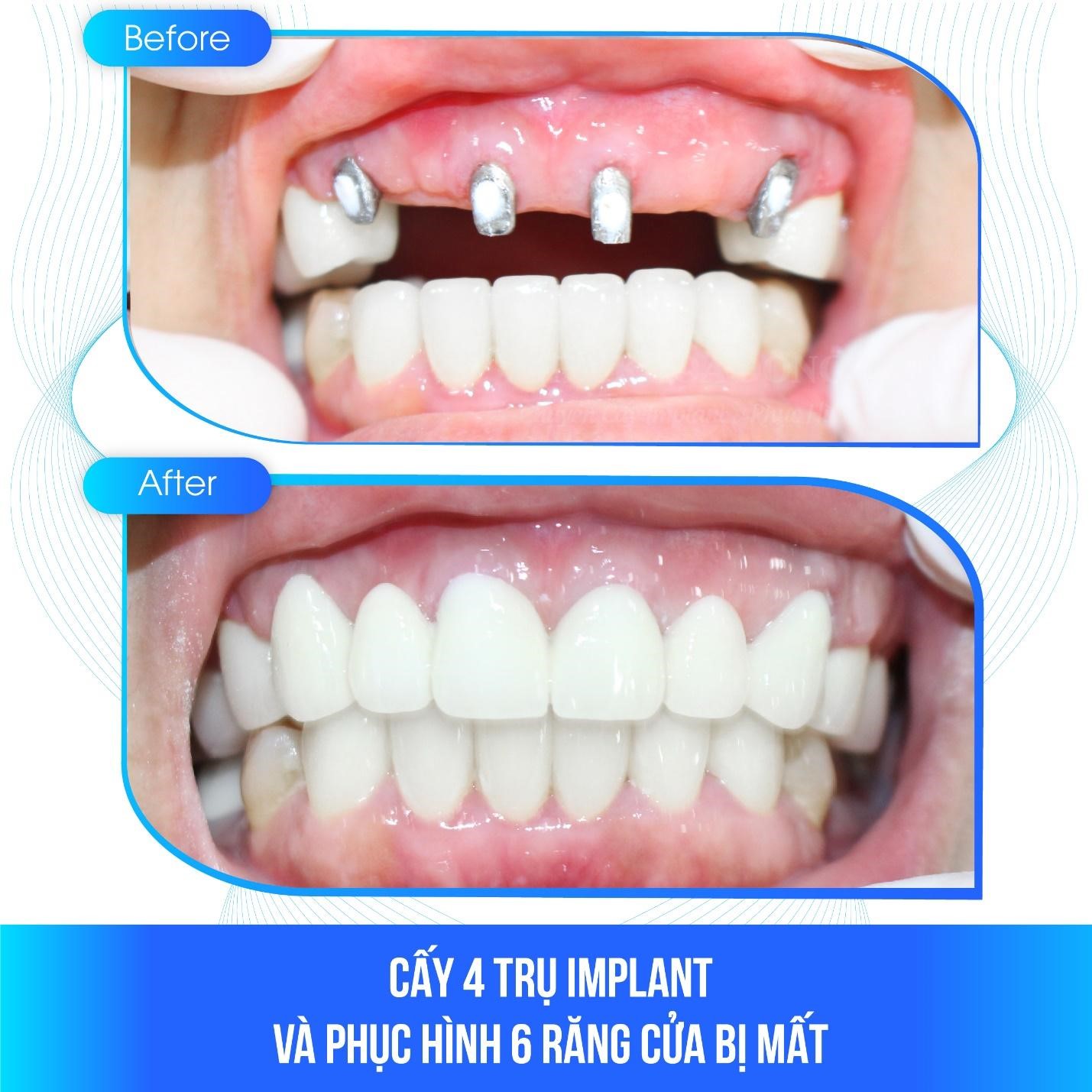 Thực tế ca cấy ghép Implant phục hồi răng cửa cho bệnh nhân.