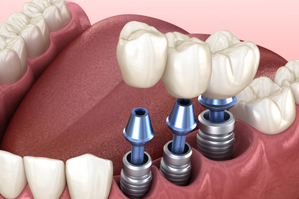 Làm răng implant giúp phục hình và cải thiện răng đã mất một cách an toàn, hiệu quả.