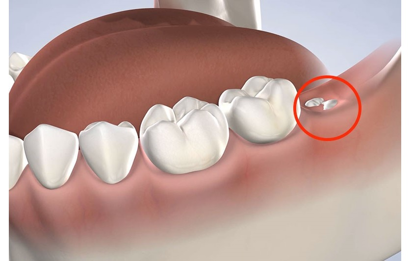 Dịch vụ nhổ răng khôn không đau tại Bệnh viện Răng Hàm Mặt Sài Gòn