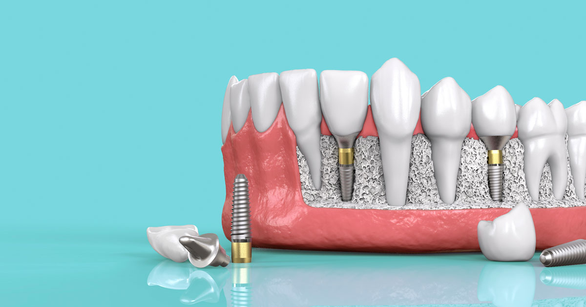 Chất liệu của trụ cắm cũng là yếu tố quyết định giá thành của một ca implant.