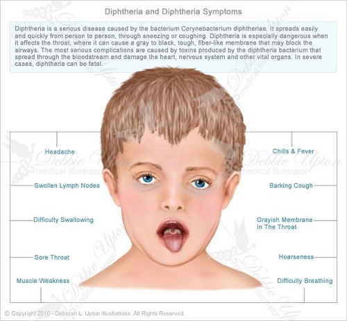 Diphtheria - Da Nang Today - News - eNewspaper